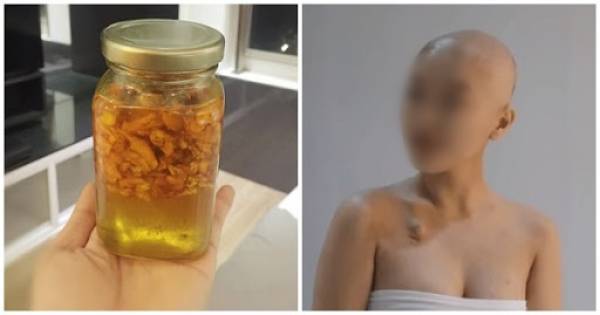 Bị ung thư bác sĩ ‘lực bất tòng tâm’, cô gái về nhà dùng gừng + mật ong, sau tái khám tế bào ung thư không còn