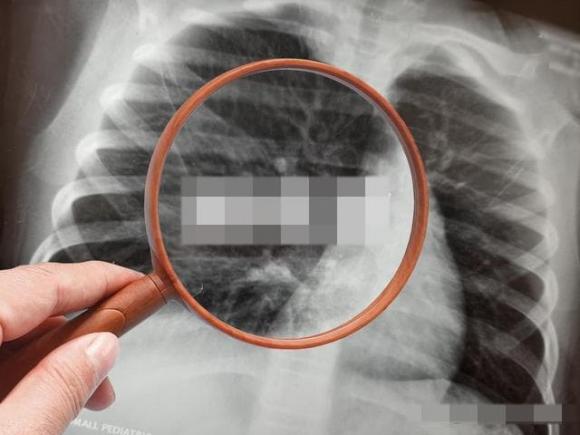 chụp ct, ᴜng thư