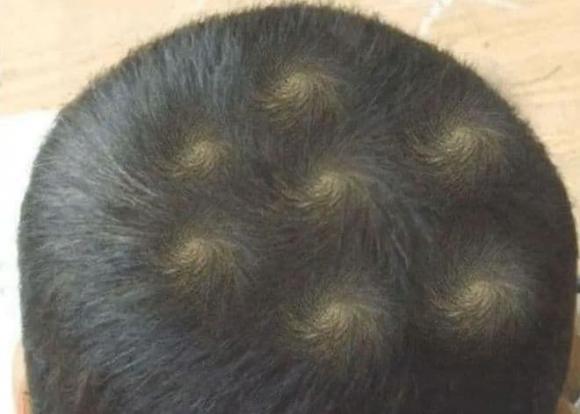 xoáy tóc, xoáy ᵭầu